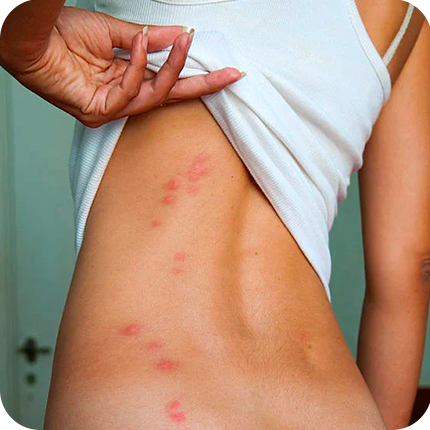 Apparence de boutons de punaises de lit